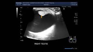 When does someone need treatment for hydrocele [upl. by Inalaeham339]