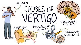 Understanding the Causes of Vertigo [upl. by Enyawad484]