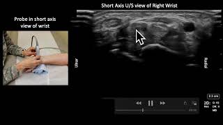 Median Nerve Anatomy and USGuided Injection [upl. by Merrie]