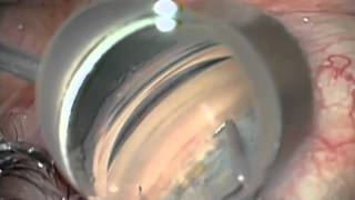 How is strabismus surgery done [upl. by Saidel]