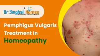 Best Homeopathic Treatment for Pemphigus Vulgaris  Dr Singhal Homeo [upl. by Thierry789]