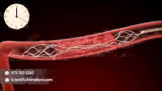 Mechanical Thrombectomy  Neurovascular stent deployment [upl. by Elleinahc200]