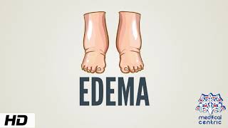 Edema Causes Signs and Symptoms Diagnosis and Treatment [upl. by Oliric]