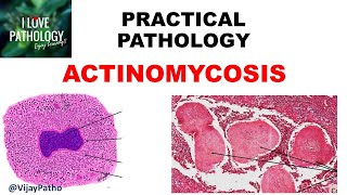 Practical Pathology ACTINOMYCOSIS [upl. by Nelo]