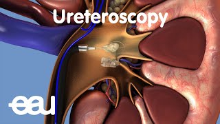 Removal of kidney stones URS [upl. by Celio]