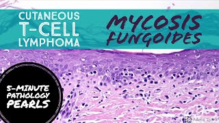 Mycosis Fungoides Cutaneous TCell Lymphoma 5Minute Pathology Pearls [upl. by Cykana]