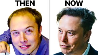 Elon Musks Hair Transplant  Surgeon Reacts [upl. by Seugram]