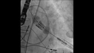 TAVRTranscatheter Aortic Valve Replacement Transapical Deployment [upl. by Fenelia295]