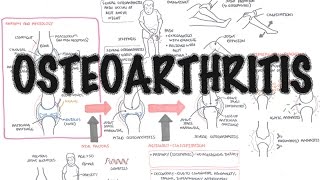 Osteoarthritis Overview causes pathophysiology investigations treatment [upl. by Dorfman]