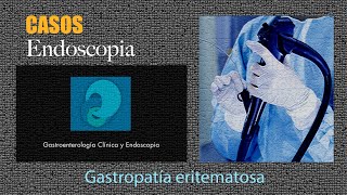 Gastropatía eritematosa [upl. by Killam]