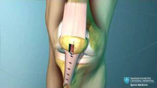 Anterior Cruciate Ligament ACL Reconstruction Animation [upl. by Atikahc]