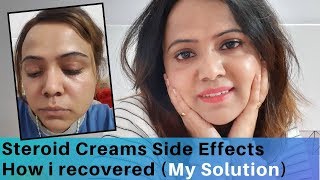 How I Recovered From Steroid cream Side Effects  My Experience  Stop using Hydroquinone [upl. by Ardnik]