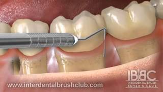 Periodontal disease causes and treatment [upl. by Maurene]