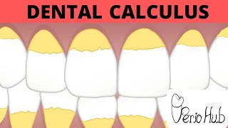 Dental Calculus Part 1 ‖ Dental Calculus Made Easy ‖ Perio Hub ‖ Dr Sneha [upl. by Sholley]