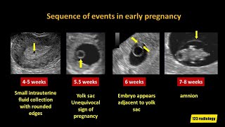 Early Pregnancy Failure A simplified Ultrasound Approach [upl. by Deeann]