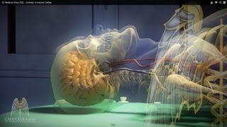 3D Medical Video HD  Cerebral Aneurysm Coiling [upl. by Ohs414]