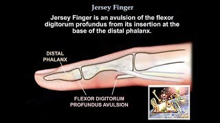 Jersey Finger  Everything You Need To Know  Dr Nabil Ebraheim [upl. by Serafine]