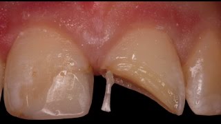 Rebuilding a Fractured Tooth with Pins [upl. by Anse]