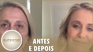 Médica explica como é feita a cirurgia de harmonização facial [upl. by Luapleahcim992]