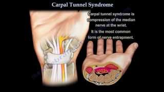 Carpal Tunnel Syndrome  Everything You Need To Know  Dr Nabil Ebraheim [upl. by Ericha]