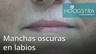 Manchas oscuras en labios 17044 [upl. by Salter]