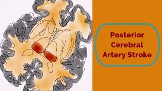 Posterior Cerebral Artery Stroke [upl. by Achilles]