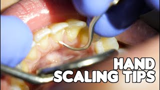 Dental Cleaning  Hand Scaling Tips [upl. by Lledroc]