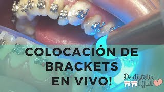 Colocación de Brackets en VIVO  Putting on Braces  LIVE [upl. by Gordan]