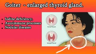 Toxic Multinodular Goiter Diagnosis and Treatment [upl. by Ttiwed366]