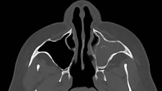 Sinus Mycetoma [upl. by Cira]