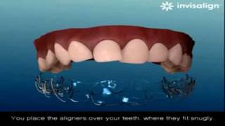 How does Invisalign work [upl. by Annahaj78]