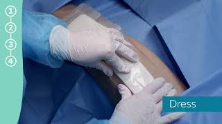 Application of the PICO System after knee surgery [upl. by Amling]