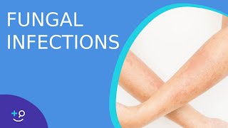 Fungal Infections  Causes Prevention and Cure [upl. by Barta]