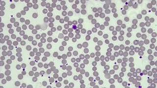 WBC Differential WBCPLT Estimate RBC Morphology [upl. by Etnahs]