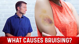 What Causes Bruising Without Trauma – Dr Berg [upl. by Ainorev]