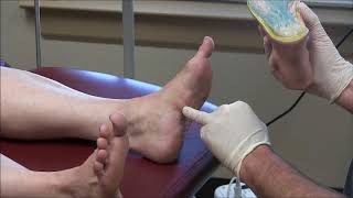 Painful Plantar Fibromas in Feet [upl. by Llerat]