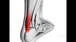 What is Achilles Tendonitis [upl. by Lamori186]