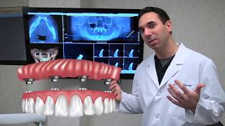 All on 4 Dental Implants Explained [upl. by Eceeryt342]