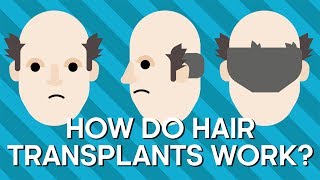 How Do Hair Transplants Work  Earth Science [upl. by Akcimahs]