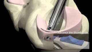 Arthroscopic Meniscus Repair [upl. by Nanyt]