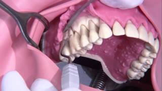 Periodontal surgery Modified Widmann flap [upl. by Edric]