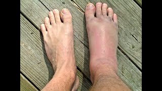 SPRAINED or BROKEN Ankle  Doctor Guide [upl. by Jehius]