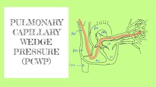 Pulmonary capillary wedge pressure PCWP [upl. by Yemane]