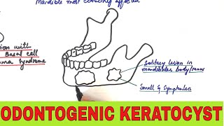 Odontogenic Keratocyst  Clinical Radiographic and Histopathologic Features [upl. by Emya187]